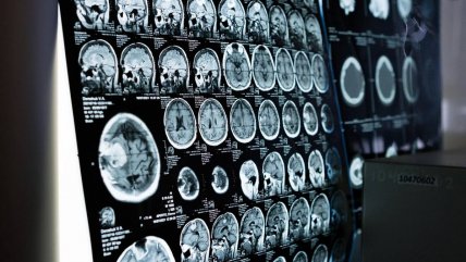   Un fármaco contra las convulsiones podría prevenir el alzhéimer 