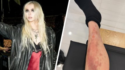   Cantante Taylor Momsen fue hospitalizada en medio de gira de AC/DC: sufrió picadura de araña 